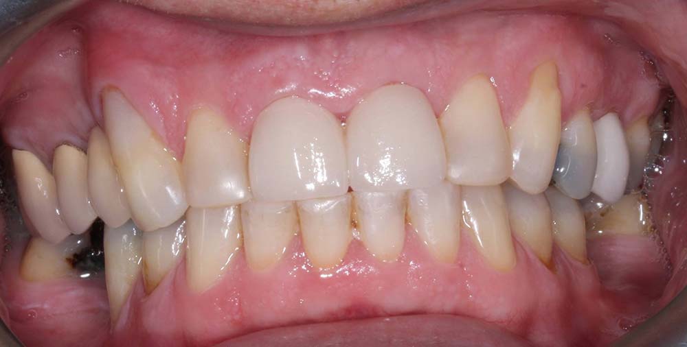 market-weighton-dental-services-cosmetic-dentistry-after01