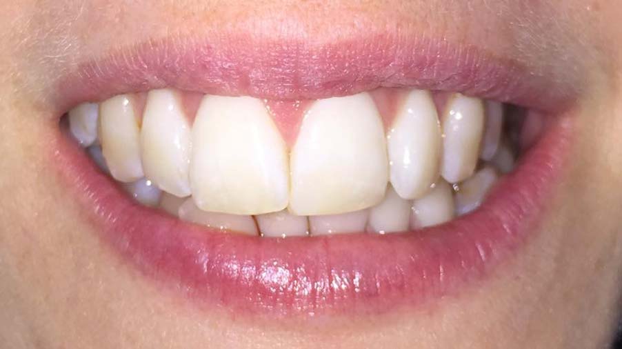 Tooth Whitening after market-weighton-dental-services-tooth-whitening-after-01
