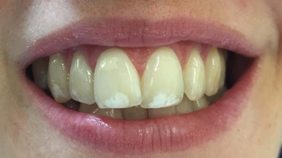 Tooth Whitening before market-weighton-dental-services-tooth-whitening-before-01