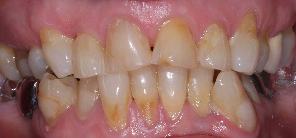 Tooth Whitening before market-weighton-dental-services-tooth-whitening-before-02